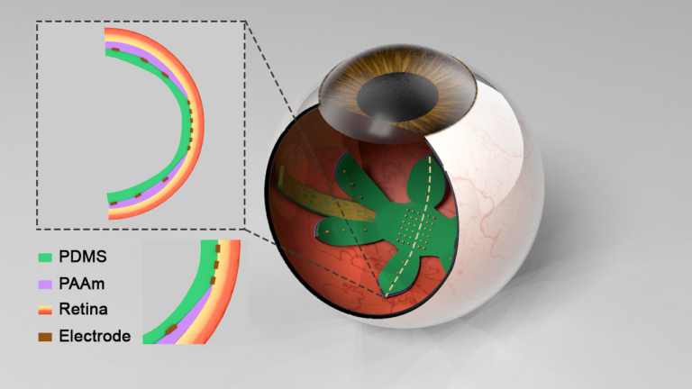 Design for retina implant
